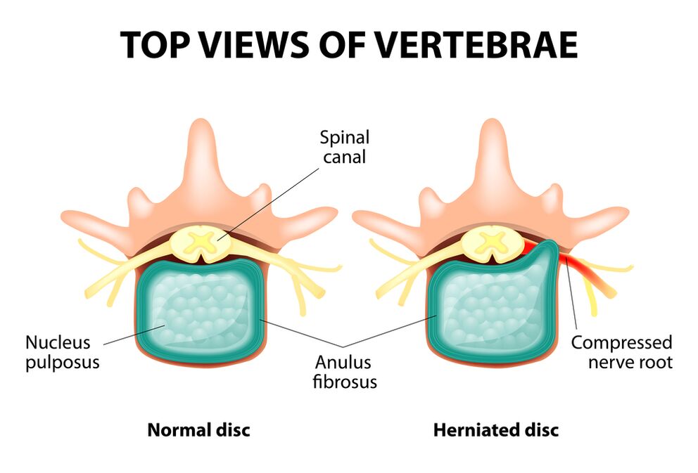 Disco intervertebrale sano ed ernia