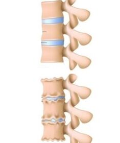 Le cause dell'osteocondosi