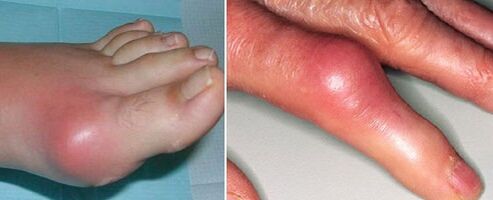 Presenza di articolazioni con artrite