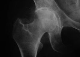 Radiografia dell'articolazione dell'anca con osteoartrosi