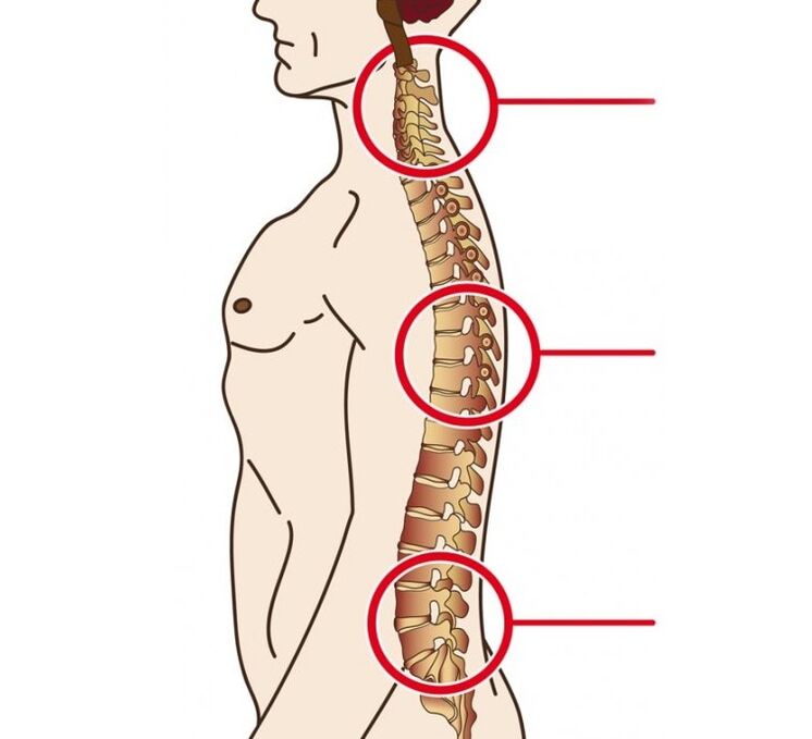 Localizzazione dell'osteocondrosi cervicale, toracica e lombare