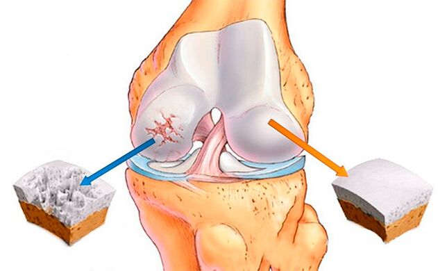 Un'articolazione del ginocchio normale (a destra) e una affetta da osteoartrosi (a sinistra)