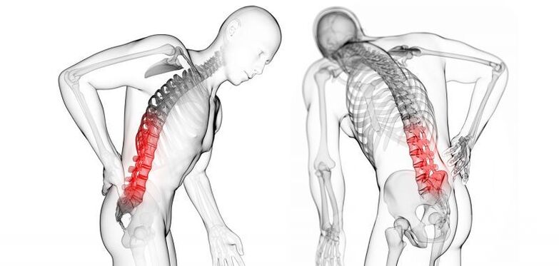 Complicanze dell'osteocondrosi cervicale